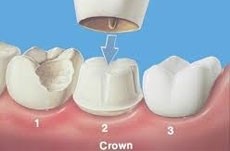 Crown on a polished tooth