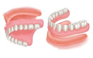 REMOVABLE DENTURE WITH FULL PLATE