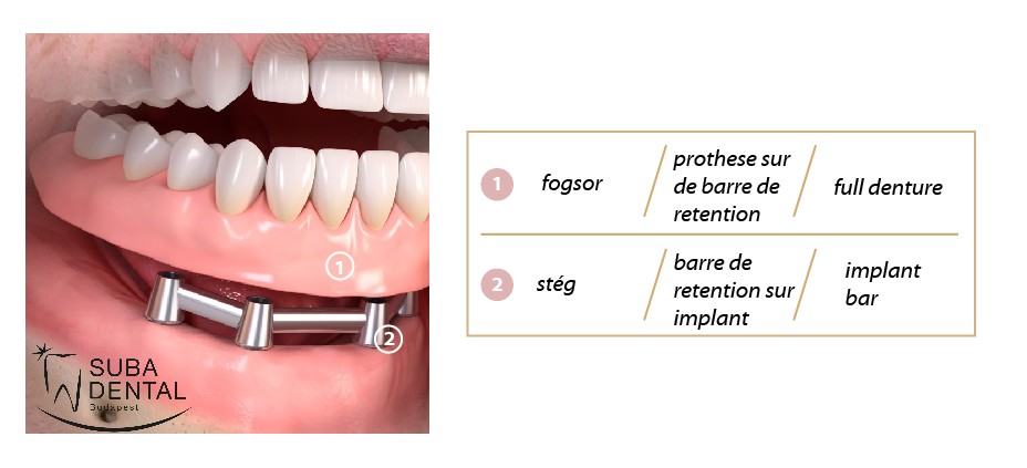 Verrou Implant RS - 10 Capsules De Rétention Femelles Transparentes - Attachement Prothèse