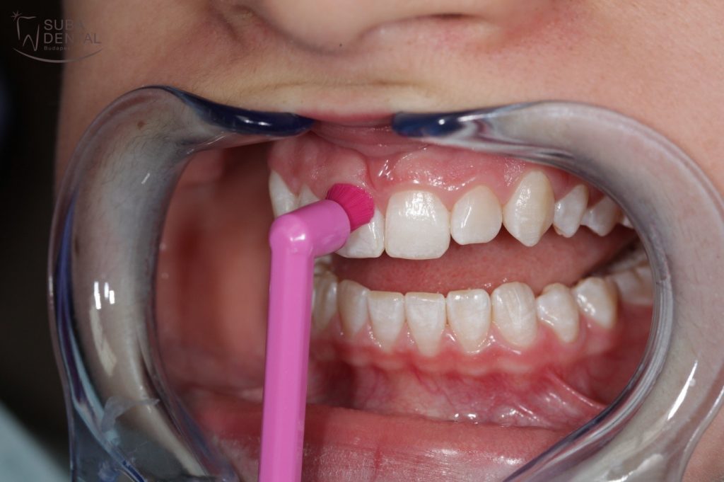 The Areas Of Use And Correct Use Of A Single Tufted Tooth Brush