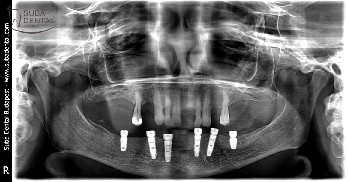 Fogászati implantátumok beültetése, ragasztható fémkerámia implantátum koronák, fix fogpótlások készítése II. kezelési fázis: fogbeültetés, implantálás (105) (Esetbemutató)