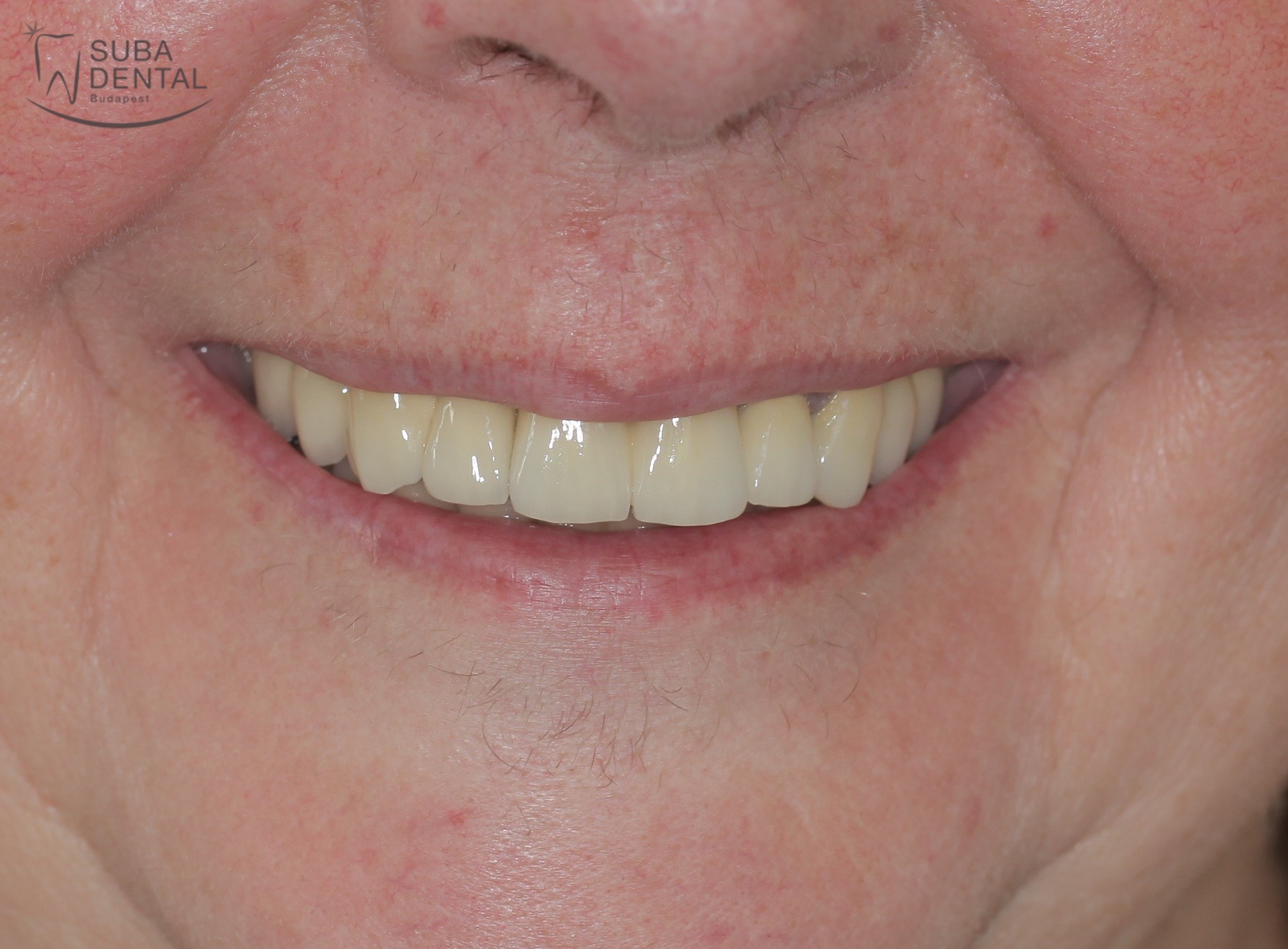 Ragasztható implantátum koronák készítése, fix fogpótlás készítése III. kezelési fázis – a végleges fémkerámia koronák és hidak készítése saját fogakra és implantátumokra (Esetbemutató) (106)